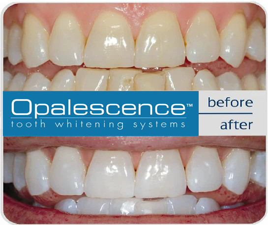 Opalescence Whitening Concentrations