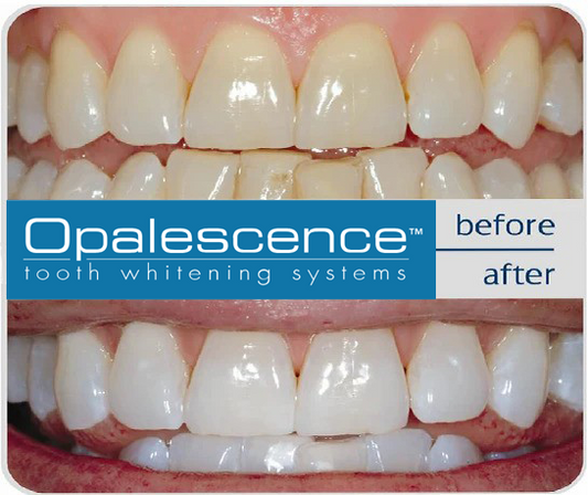 Opalescence Whitening Concentrations