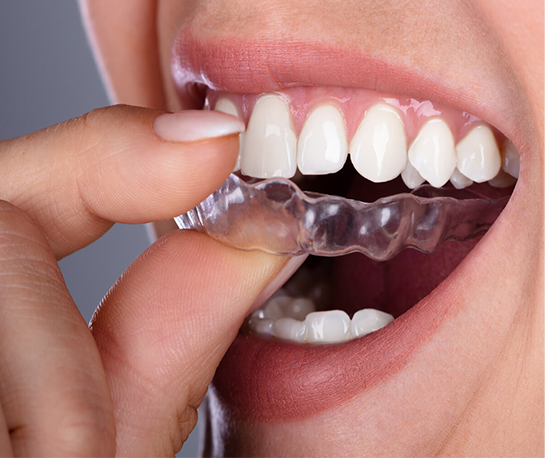 Opalescence Whitening UK